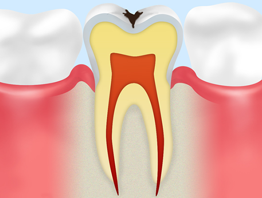 エナメル質むし歯（C1）