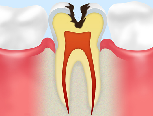 象牙質むし歯（C2）