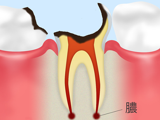 歯の根っこしか残っていないむし歯（C4）